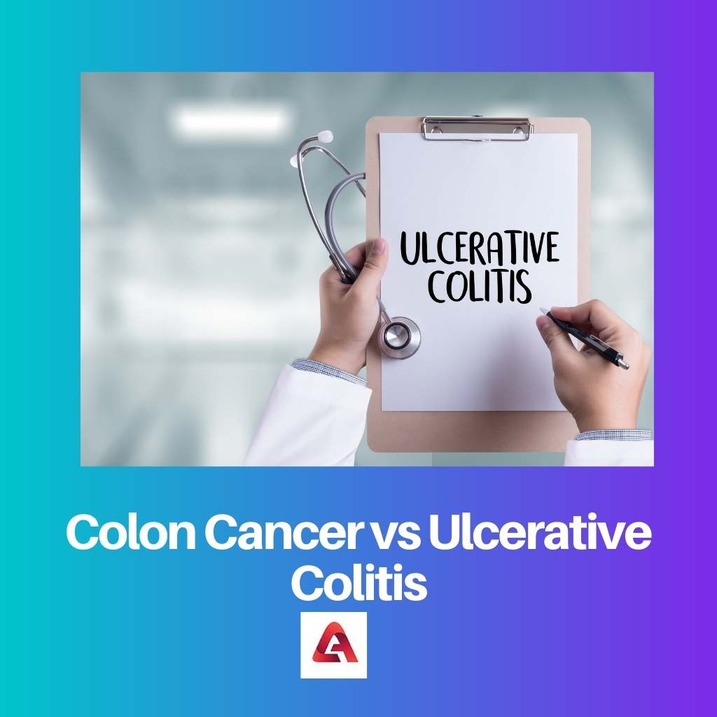 Colon Cancer vs Ulcerative Colitis