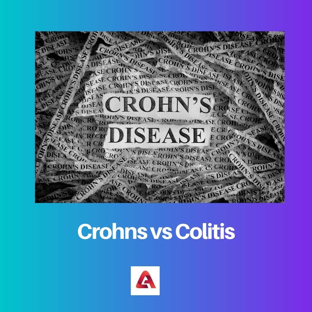 Crohns vs Colitis