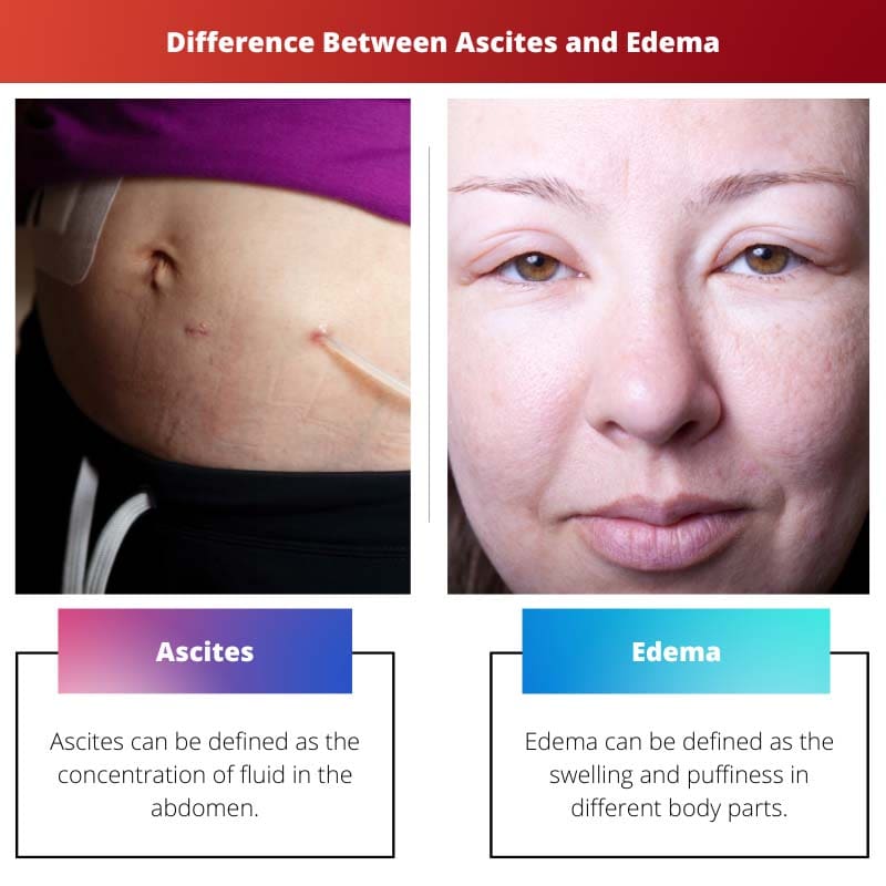Difference Between Ascites and Edema