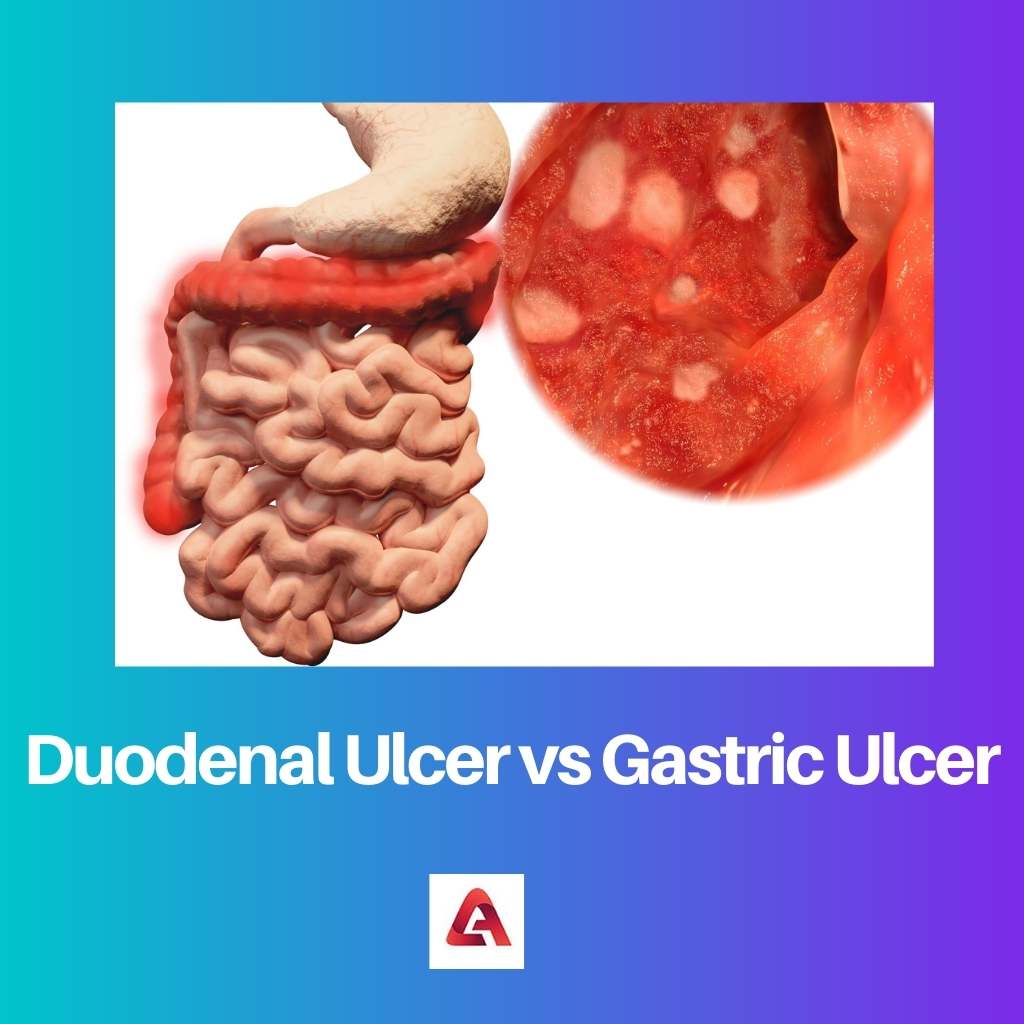 Duodenal Ulcer vs Gastric Ulcer