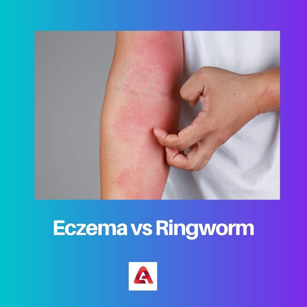 Eczema vs Ringworm