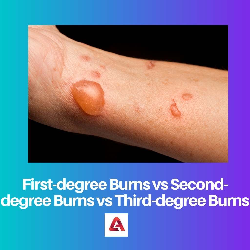 First degree Burns vs Second degree Burns vs Third degree Burns