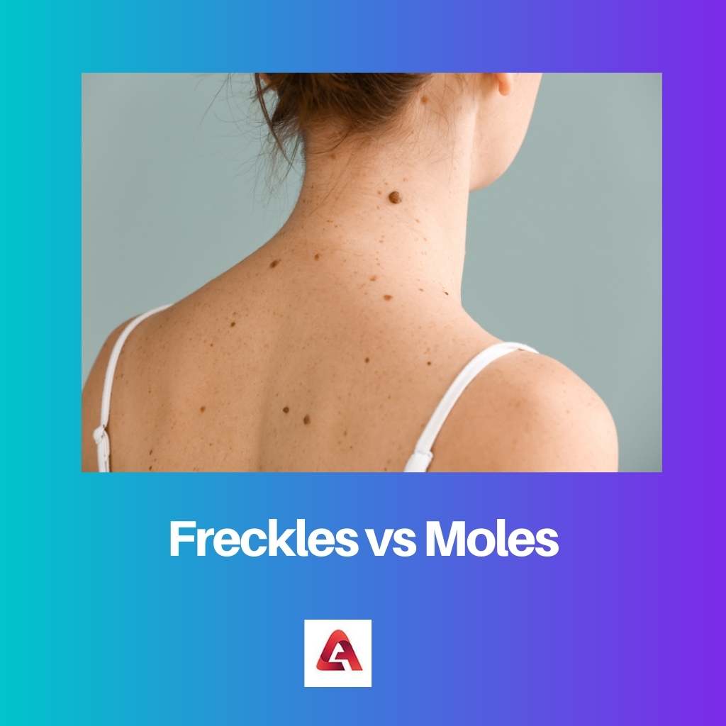 Freckles vs Moles