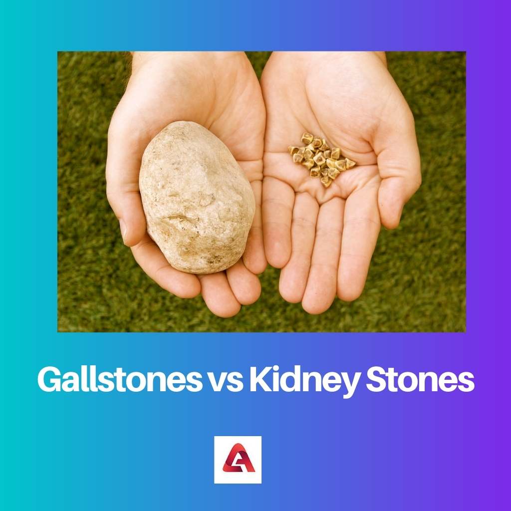 Gallstones vs Kidney Stones