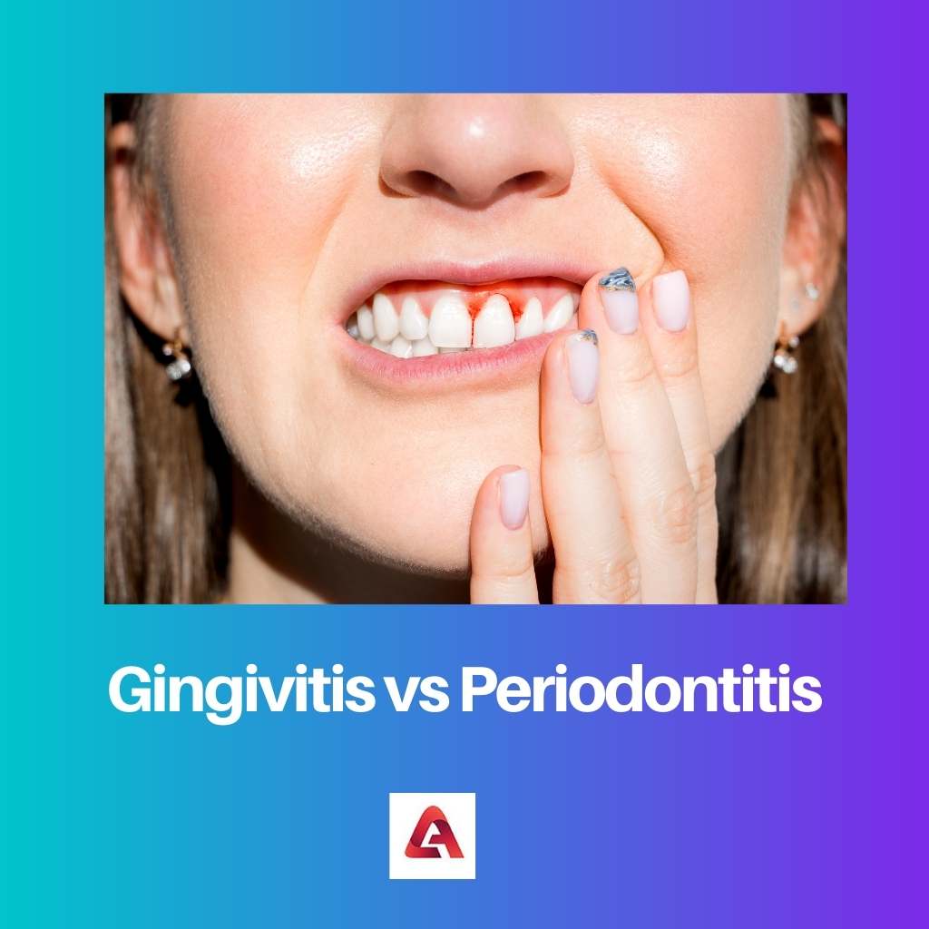 Gingivitis vs Periodontitis