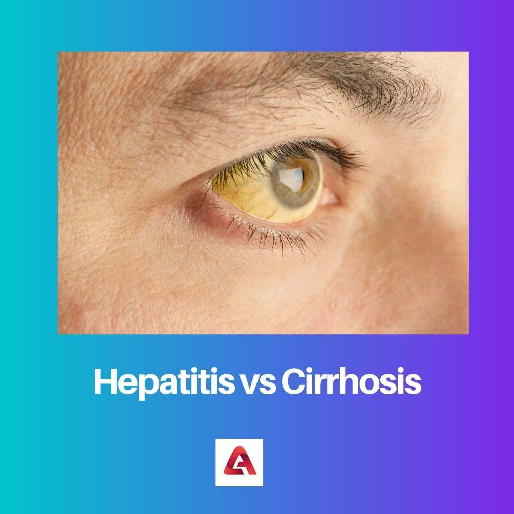 Hepatitis Vs Sirosis: Perbedaan Dan Perbandingan