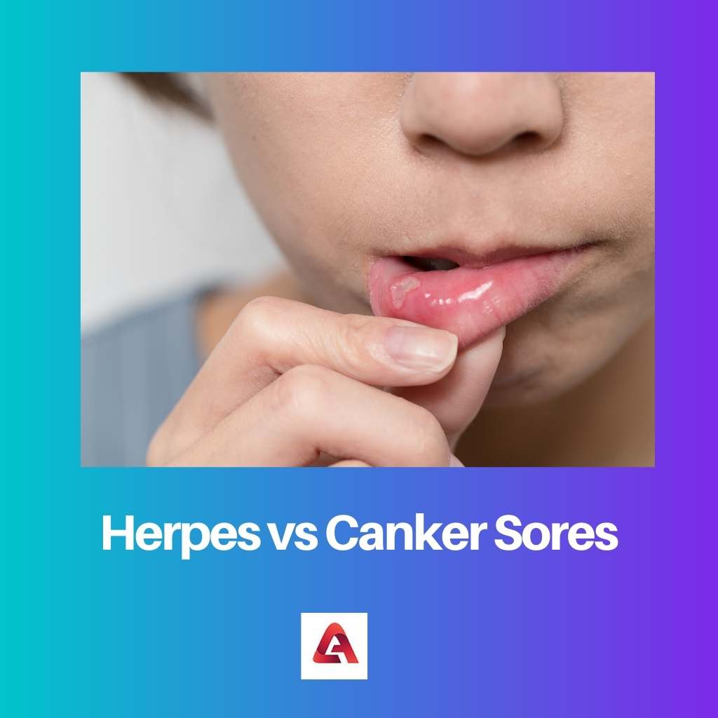 Herpes vs Canker Sores