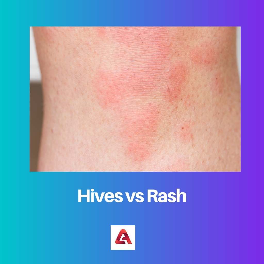 Hives vs Rash