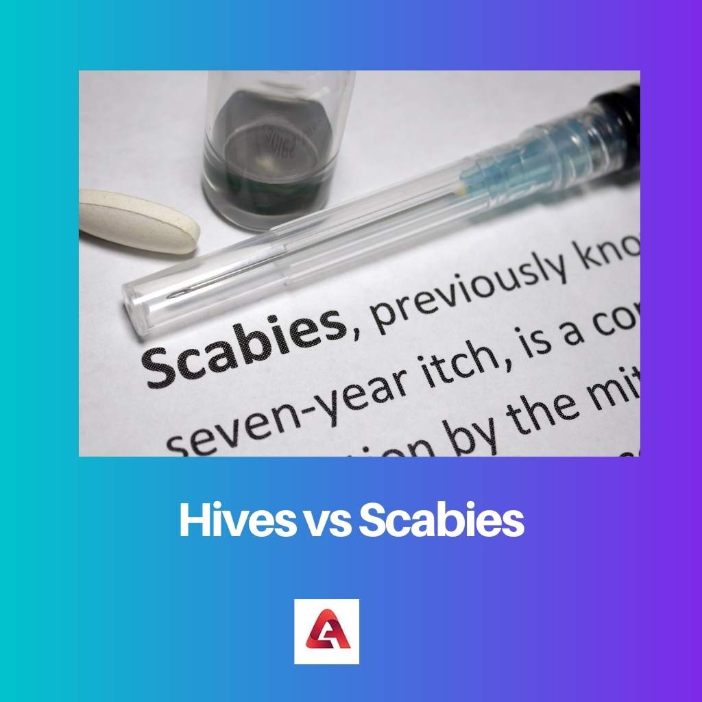 Hives vs Scabies