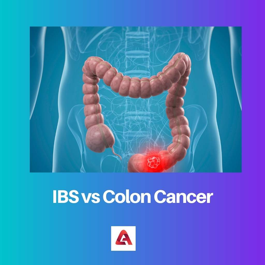 IBS vs Colon Cancer 1