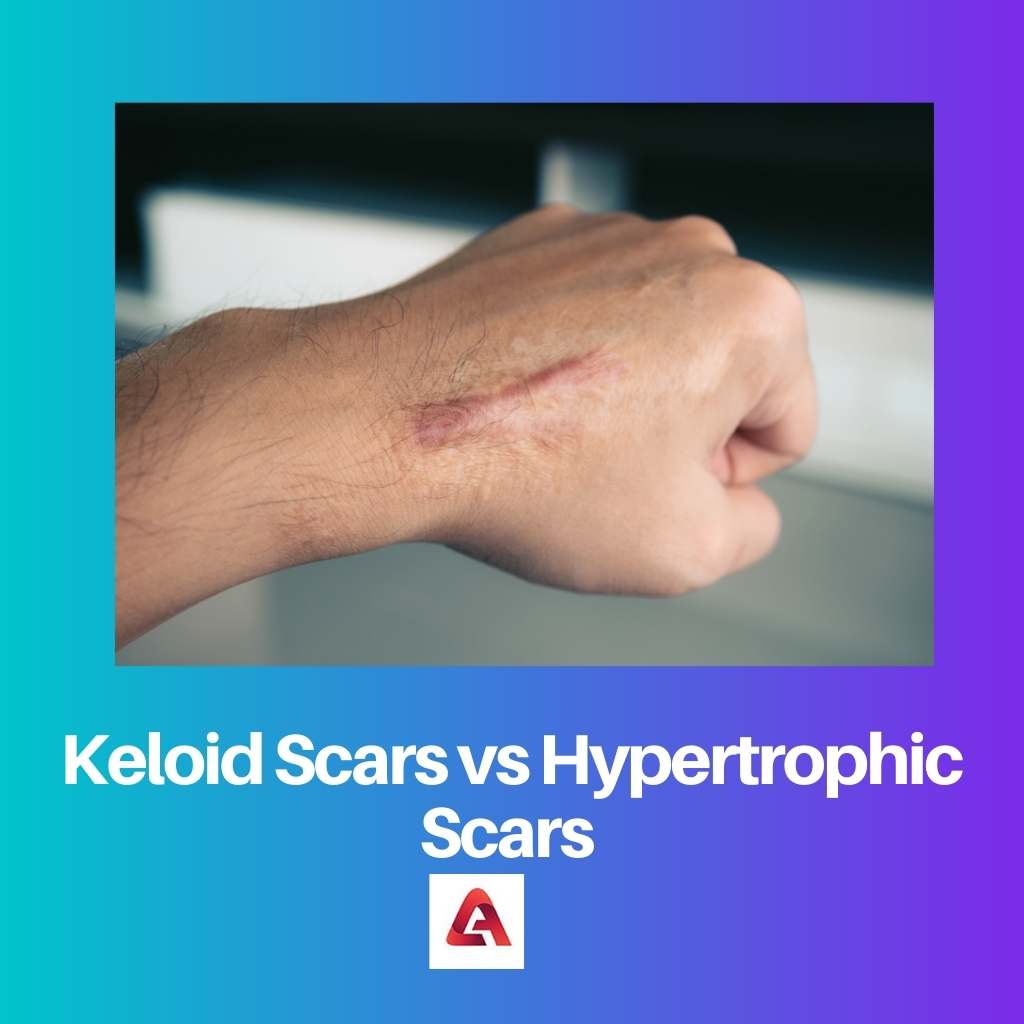 Keloid Scars vs Hypertrophic Scars