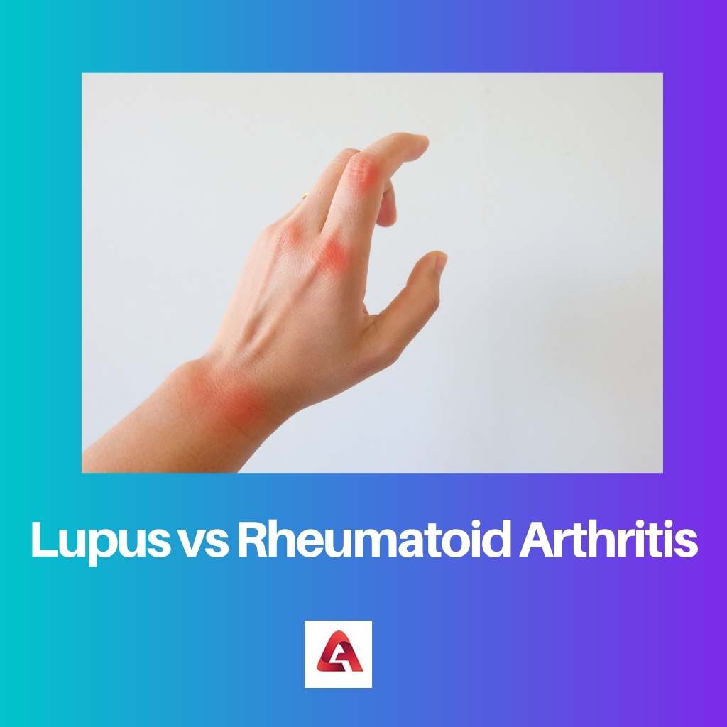 Lupus vs Rheumatoid Arthritis