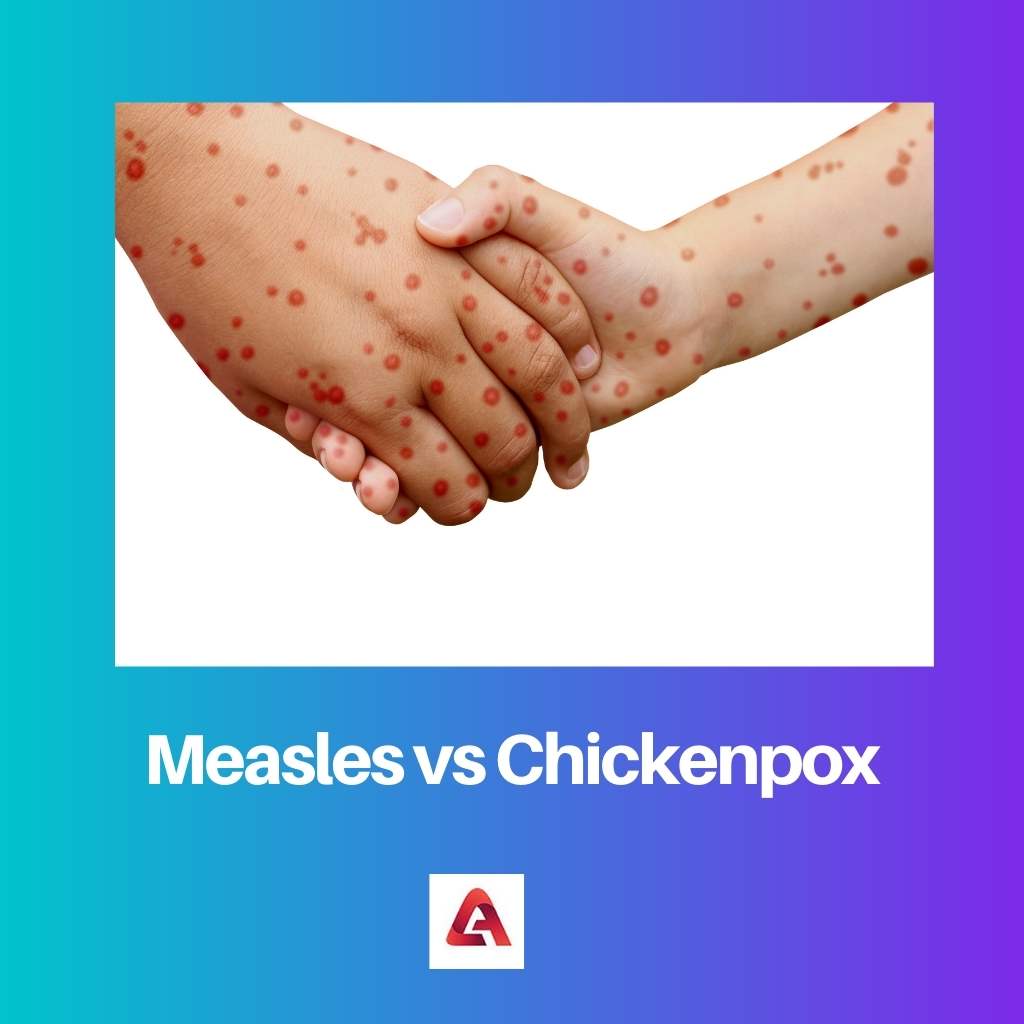 Measles vs