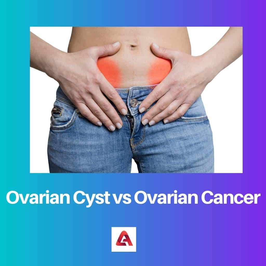 Ovarian Cyst Vs Ovarian Cancer: Difference And Comparison