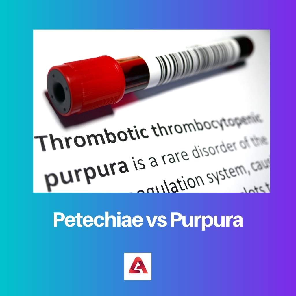 Petechiae vs Purpura