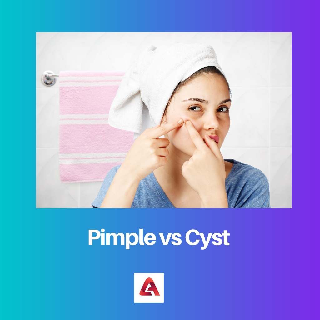 Pimple vs Cyst