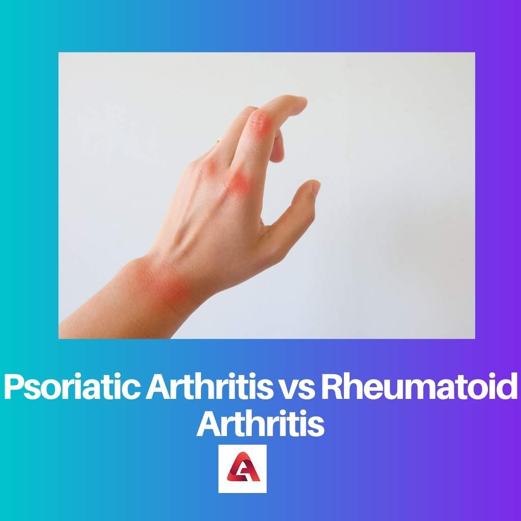 Psoriatic Arthritis vs Rheumatoid Arthritis