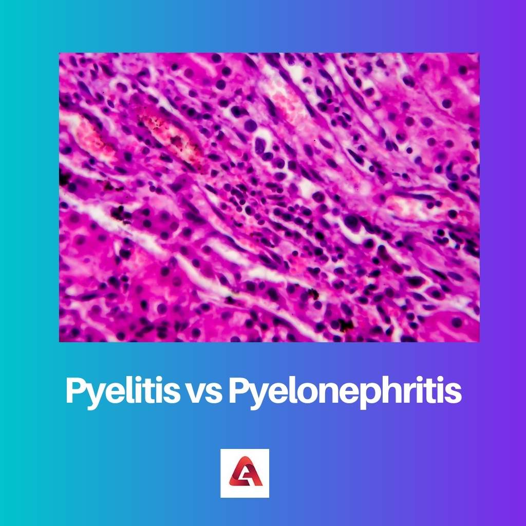 Pyelitis vs Pyelonephritis