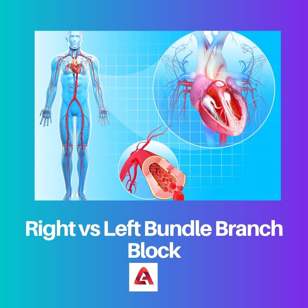 Right vs Left Bundle Branch Block 1