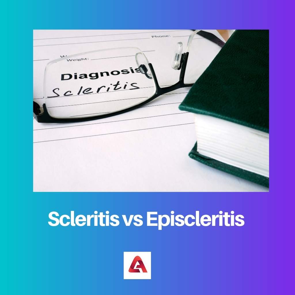 Scleritis vs Episcleritis