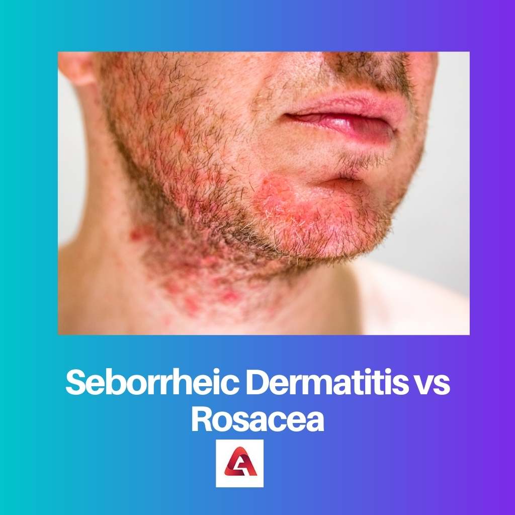 Seborrheic Dermatitis vs Rosacea