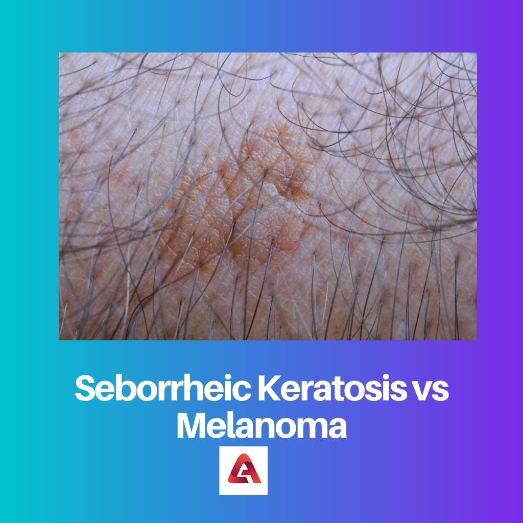 Seborrheic Keratosis vs Melanoma