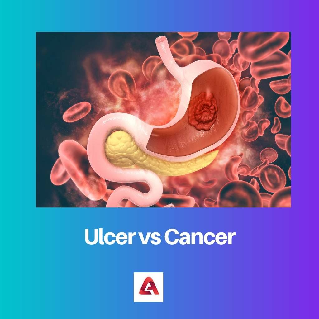 Ulcer vs Cancer