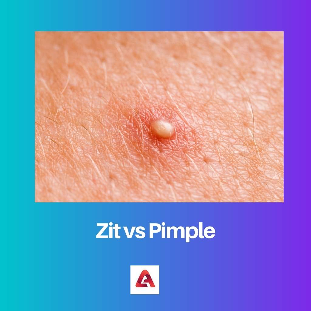 Zit vs Pimple