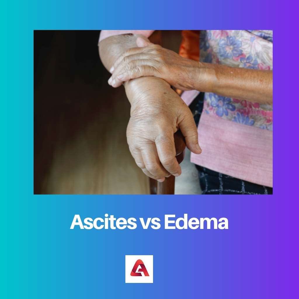 Ascites vs Edema