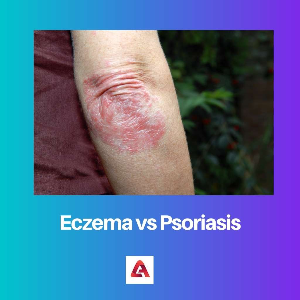 Eczema vs Psoriasis
