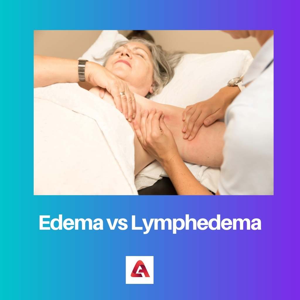 Edema vs Lymphedema