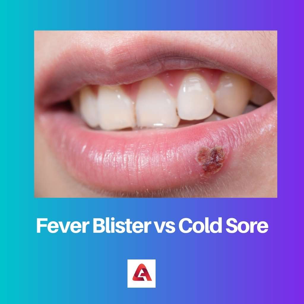 Fever Blister vs Cold Sore