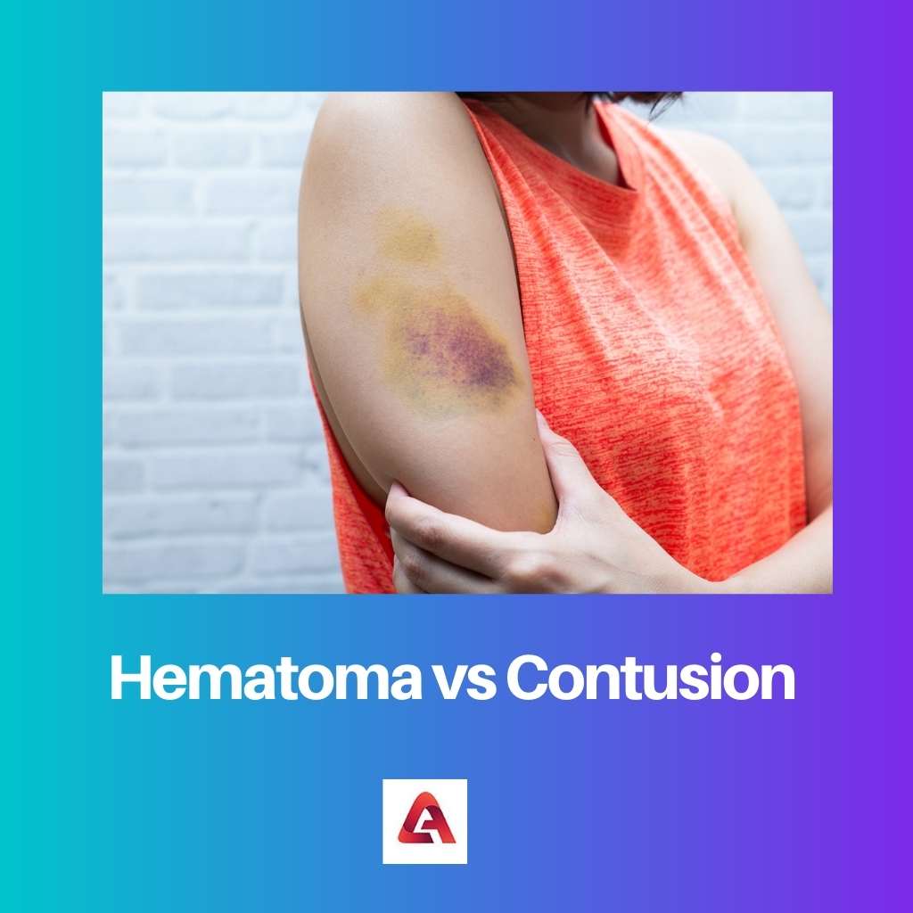 Hematoma vs Contusion