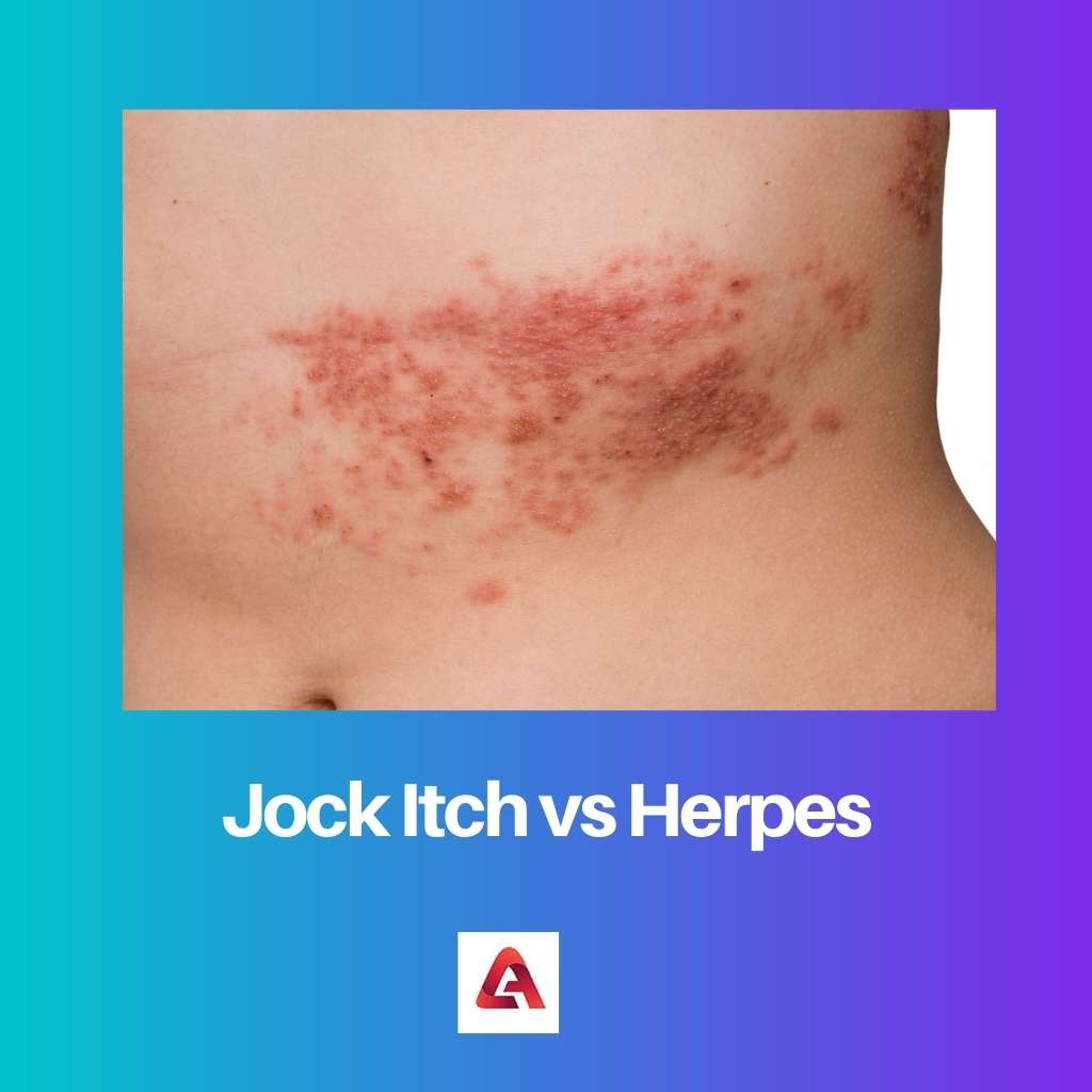 Jock Itch vs Herpes