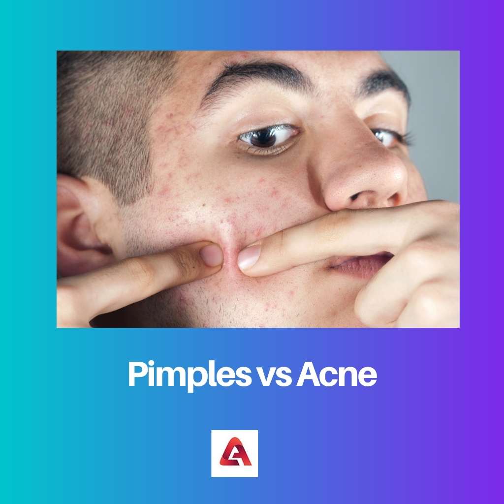 Pimples vs Acne