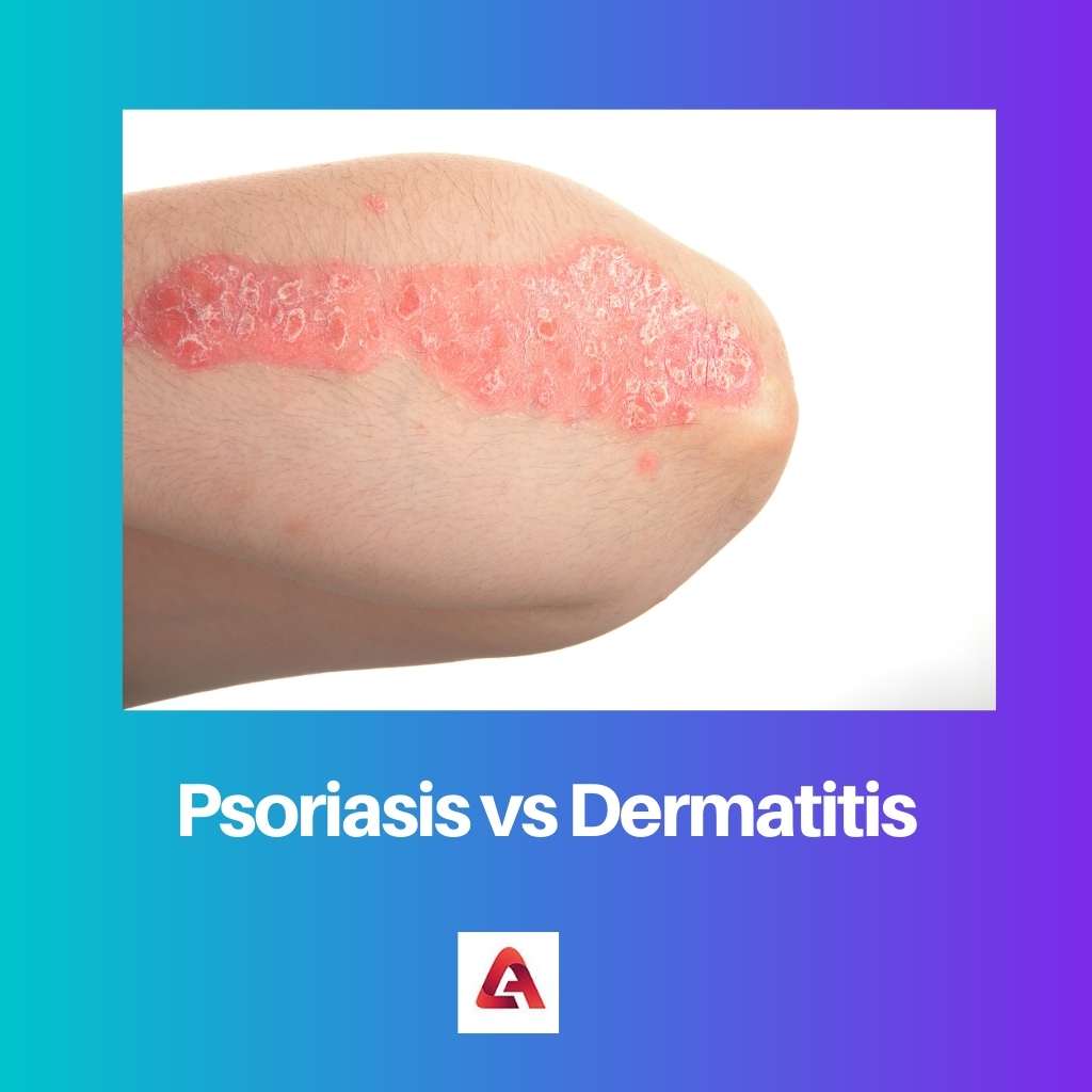 Psoriasis vs Dermatitis